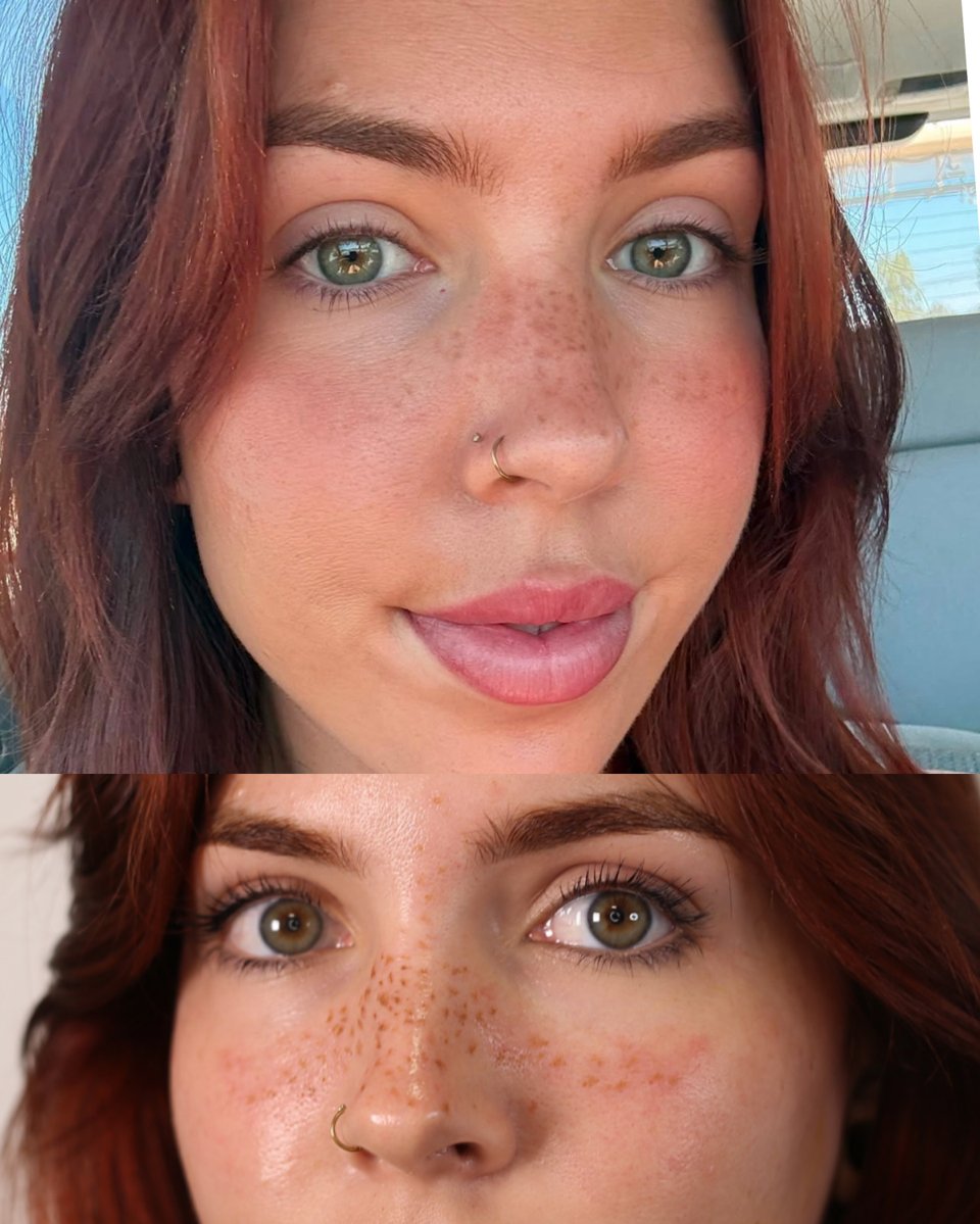 Side-by-side fresh and healed faux freckles on the same client at PMU by the Sea in Oceanside